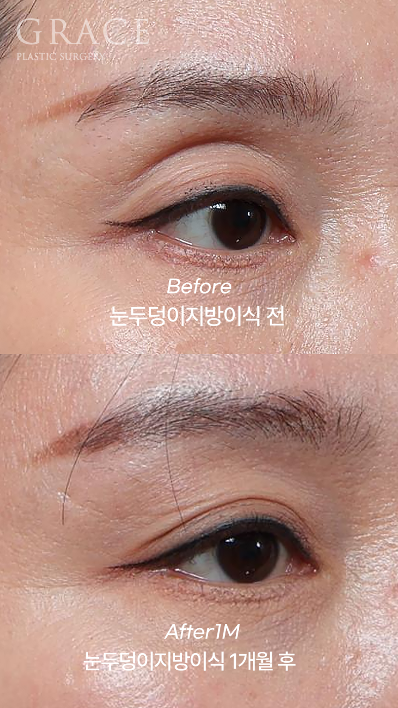 눈두덩이 지방이식 비용부터 붓기·후기·부작용까지