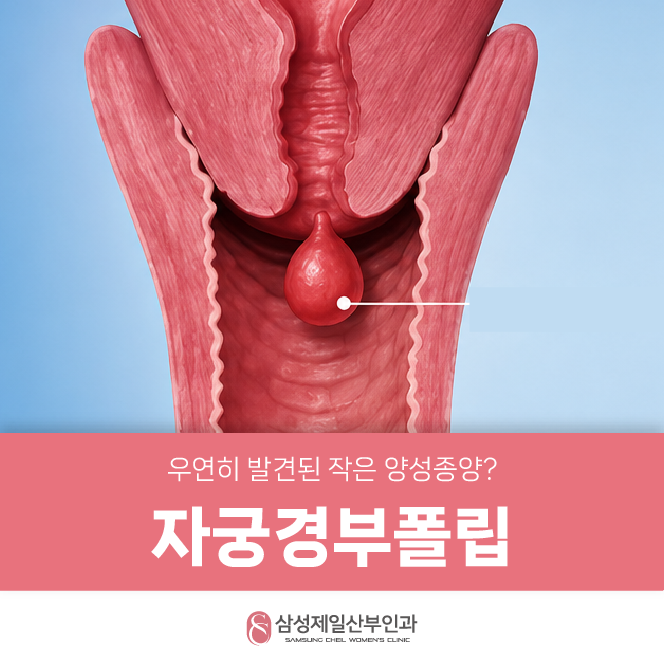 인덕원 산부인과, 우연히 발견된 작은 양성종양? "자궁경부폴립"