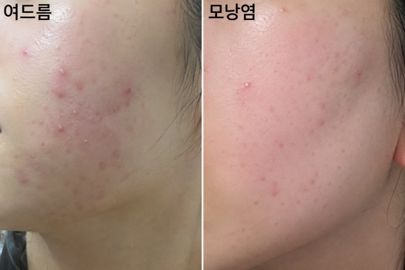 모낭염, 여드름인 줄 알았는데 자꾸 재발한다면? 원인부터 셀프케어까지 총정리