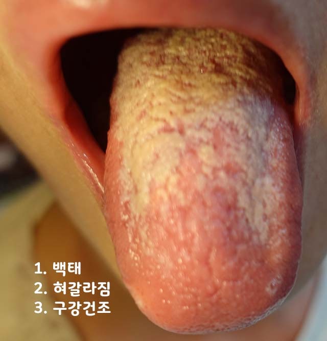 구강작열증후군 - 심층 분석