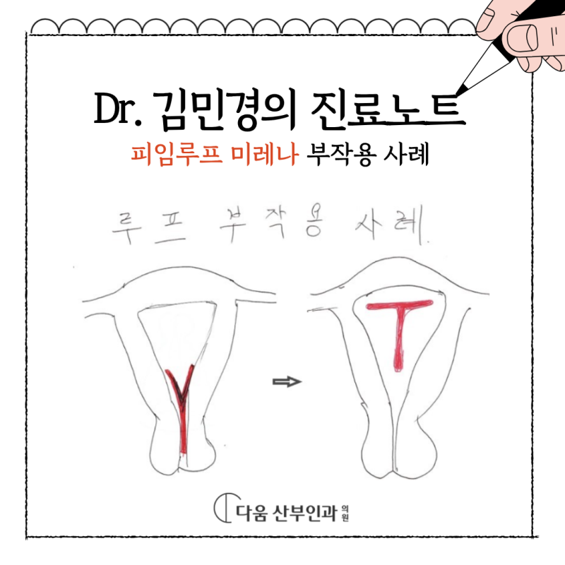 피임루프 미레나 부작용, 갑자기 부정출혈이 생겼다면 확인하세요.