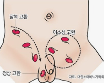 잠복고환과 이동성 고환, 상승고환은 어떻게 다를까요?