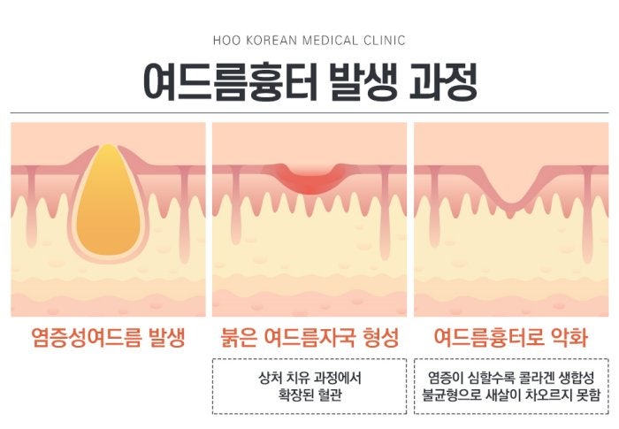 10년 넘은 여드름흉터도 지금 치료할 수 있을까요(전주 후한의원)