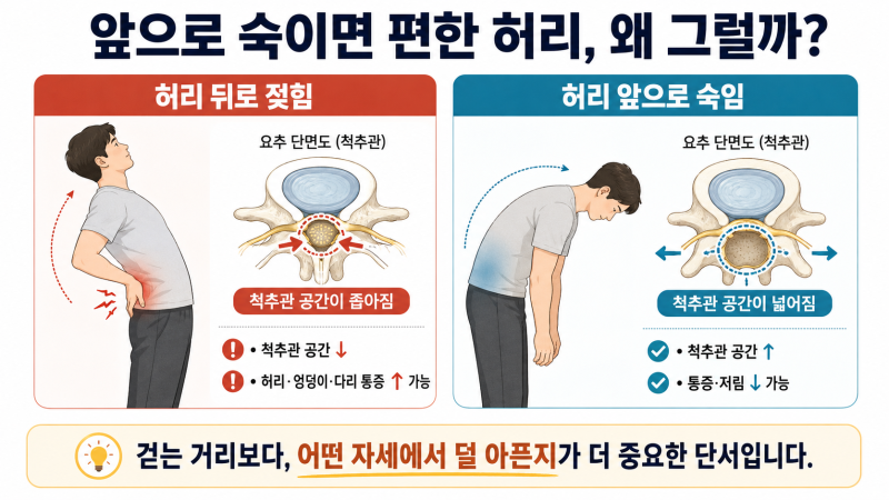 허리 숙일 땐 괜찮은데 뒤로 젖힐 때 아프다? 디스크보다 ‘협착증 패턴’을 먼저 보세요