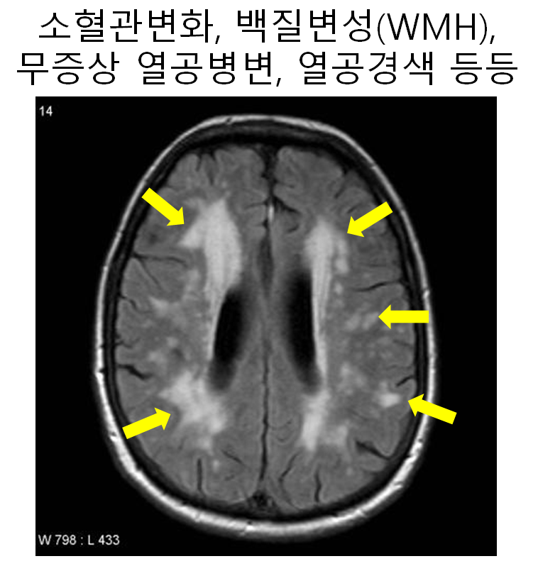 뇌 MRI MRA 를 통해 알 수 있는 것들, 봉천역 신경과 2호선신경과