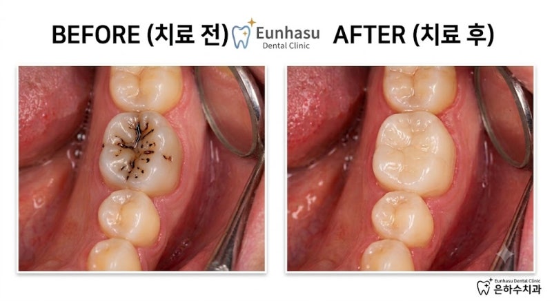 '레진' 치료의 모든 것! (가능 부위·장단점·주의사항)