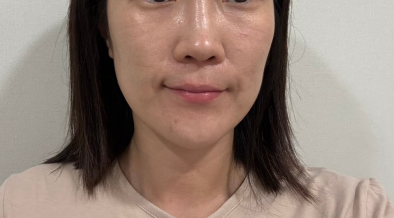 대구 편평사마귀제거 한의원 거우침치료 후기