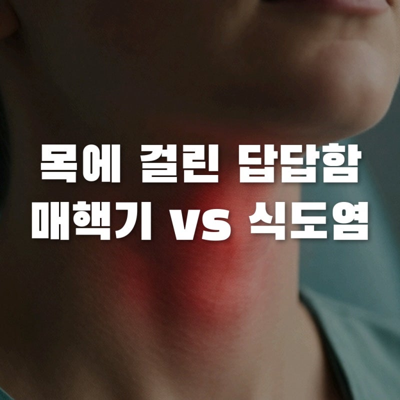 목구멍이물감 매핵기, 단순한 느낌일까 역류성식도염증상일까?