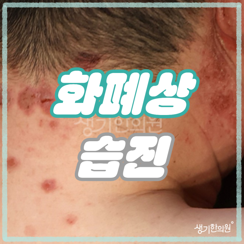 노원 화폐상습진 동전 모양 가려움증을 가라앉히는 현실적인 방법