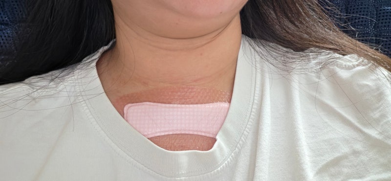 칠곡 경대병원 갑상선 수술 후기 (3)