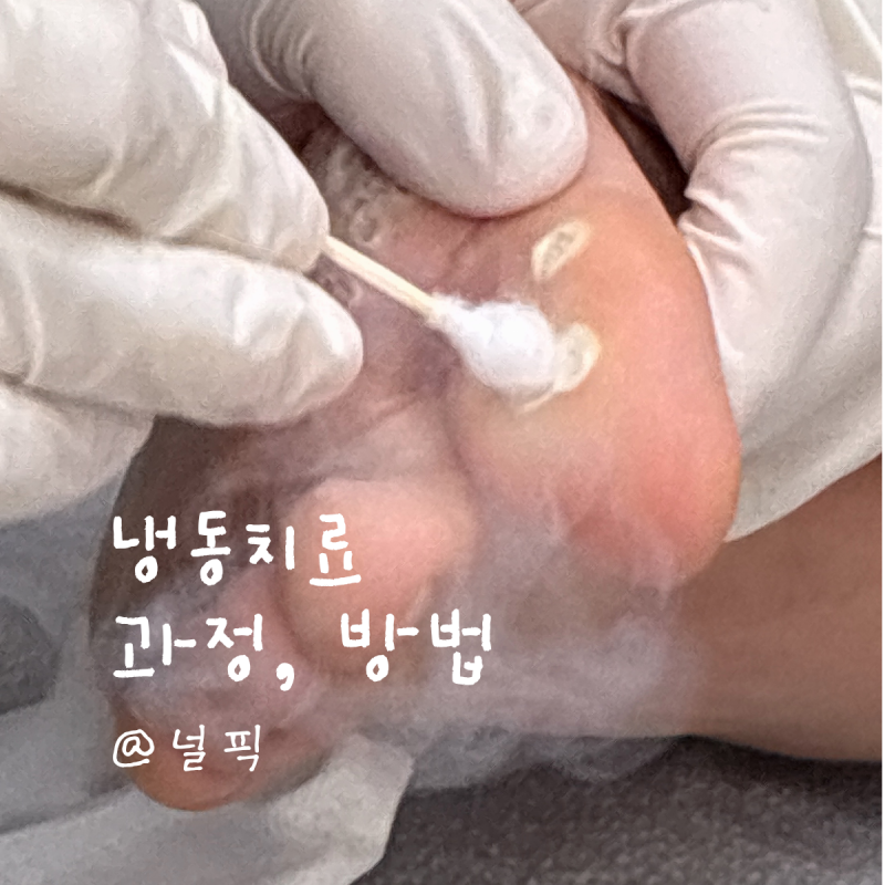 발바닥 사마귀 냉동치료, 물집 소독법 / 통증 관리 꿀팁