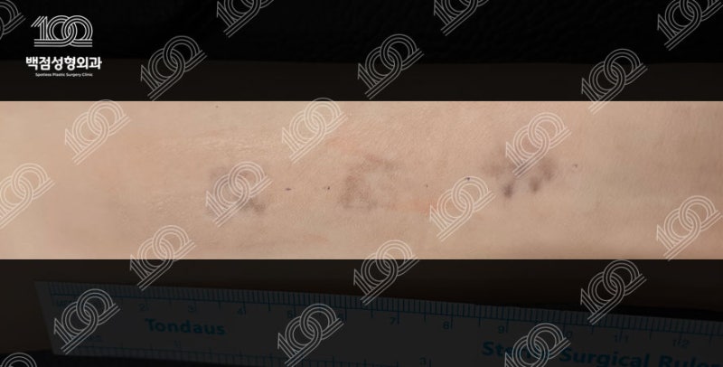 문신 타투 제거 수술 후 흉터 최소화 관리방법