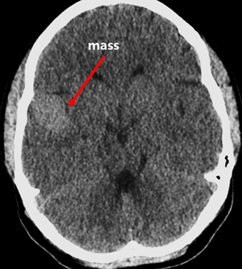 Case Review_238-두통을 호소하는 22세 여성-중대뇌동맥류(MCA aneurysm)