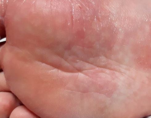 “가려워서 긁었더니 물집이 더 늘었다” 발 한포진이 반복해서 악화되는 과정