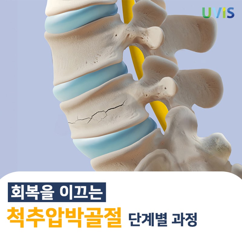 척추압박골절 완치를 향한 단계별 회복 과정과 필수 주의사항