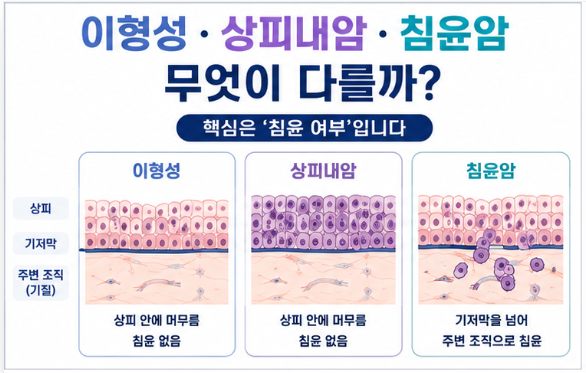 이형성·상피내암·침윤암 차이, 조직검사 결과에서 어떻게 구분할까?