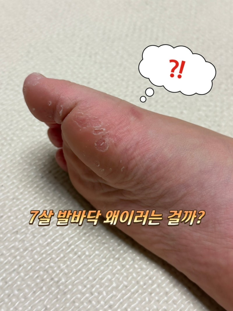 7살 아이 발바닥 습진? 무좀? 수족구 후유증?