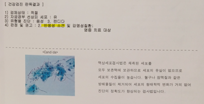 자궁경부암검진 반응성세포변화, 부정출혈· 질 분비물이 지속된다면?