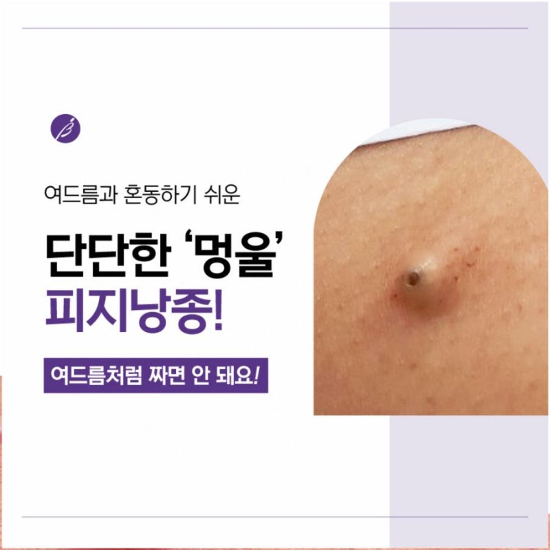 귓볼 피지낭종, 귀에 만져지는 작은 몽우리의 원인과 제거!