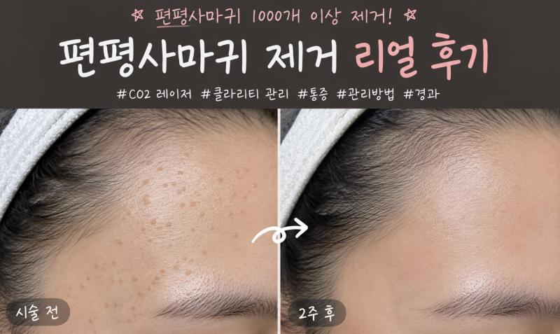 얼굴 편평사마귀 제거 후기 및 가격 시술 후 관리 방법