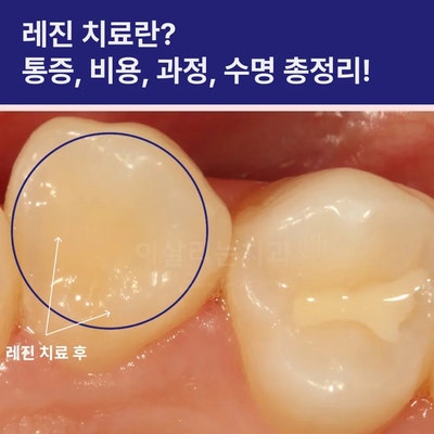 레진 치료란? 과정, 비용, 통증, 수명 알려드려요.