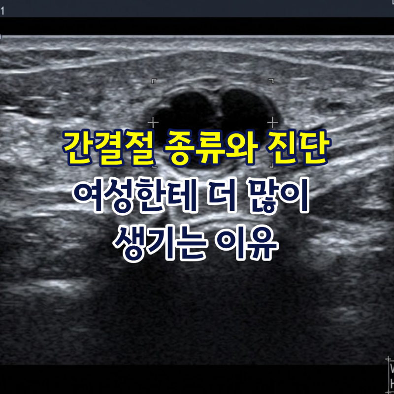 간결절 종류와 진단, 여성한테 더 많이 생기는 이유