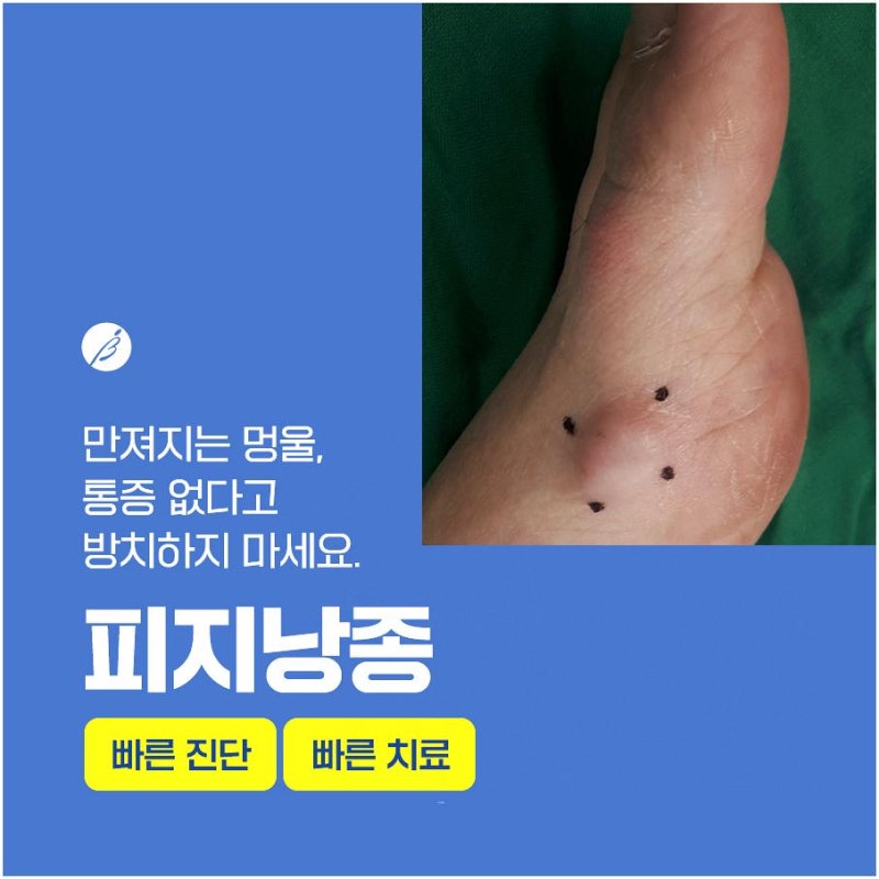 피지낭종 병원 어떤 점을 체크해야 할까?