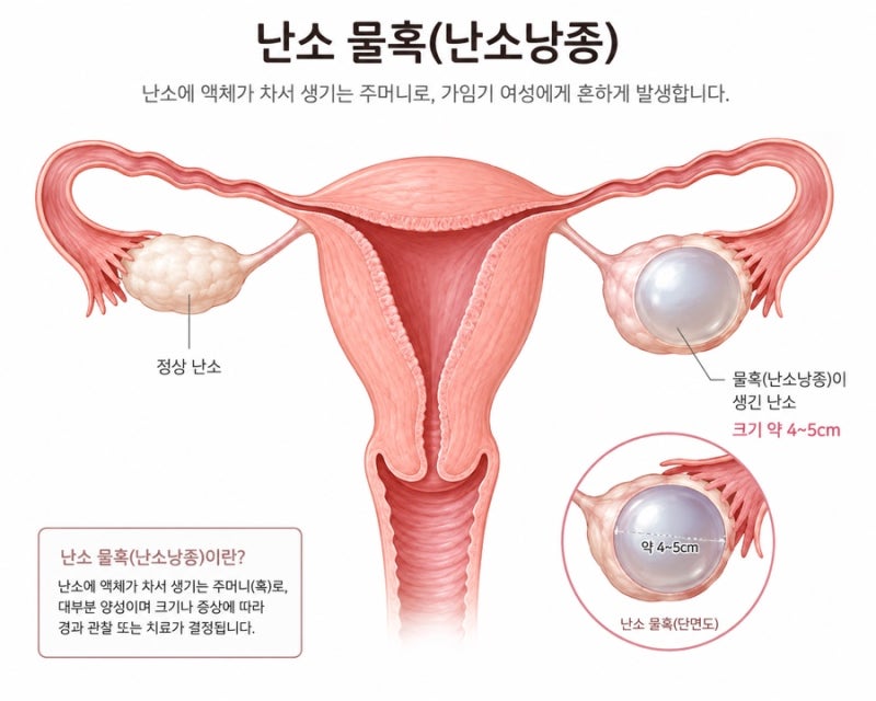 (난소물혹 1편) 비잔정부작용...난소낭종 포스팅을 하게 된 이유 / 두드러기로 고생한다는 말....