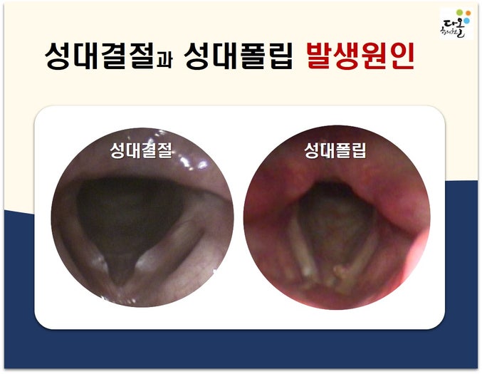 성대결절 ,성대폴립 말하면서 치료할 수 있을까? - 원인,증상,치료,Q&A