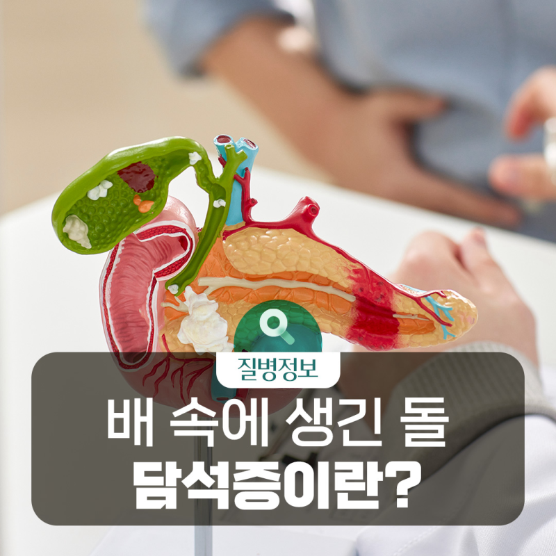 [질병돋보기] 기름진 음식 먹고 오른쪽 윗배가 아프다면? 담석증 증상부터 치료·예방법까지