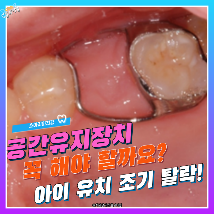 공간유지장치 꼭 해야 할까요? 아이 유치가 일찍 빠졌다면 확인해야 하는 이유