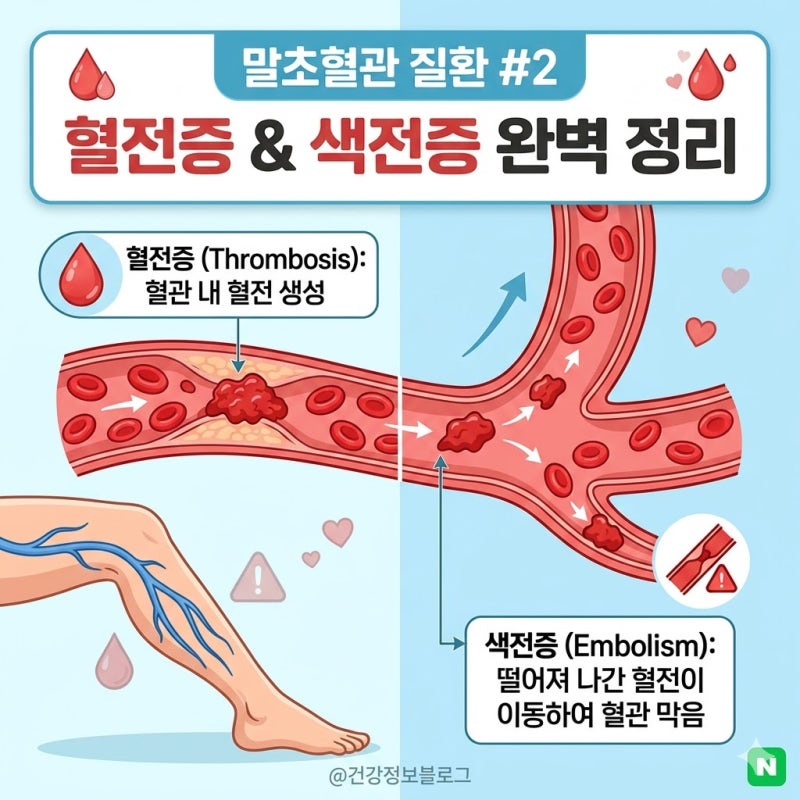 [혈관건강]혈전증vs색전증 차이점,증상,치료법 알아보기
