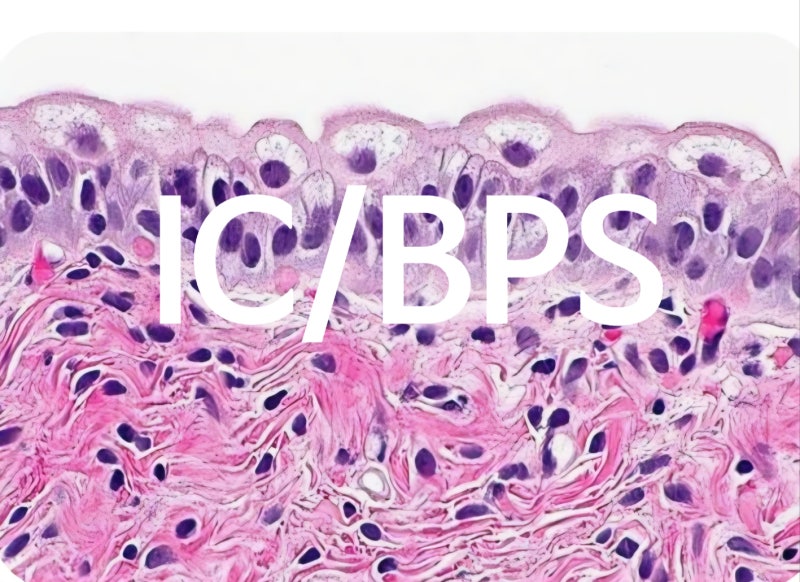 IC/BPS(간질성방광염과 방광통증증후군)