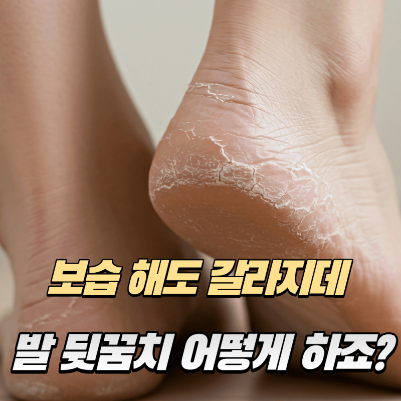 보습 열심히 해도 발뒤꿈치가 계속 갈라진다면 이것 때문일 수 있어요