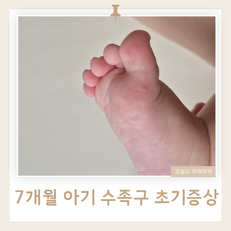 7개월 아기 수족구 초기증상 39도 고열로 아이퍼스트 아동병원 다녀온 후기