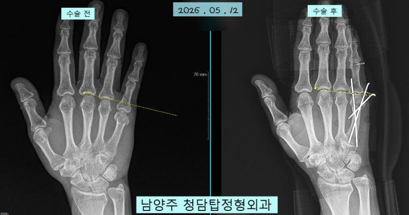 '3분 핀 고정술' = 손가락 골절시 수술비가 부담될 때 할 수 있는 좋은 간단한 치료법