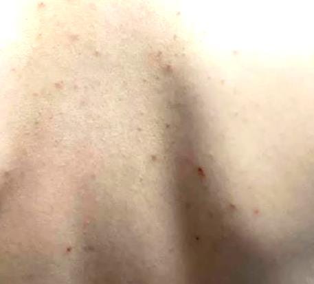 남자 여자 가드름 등드름 없애는법 흉터 까지 싹