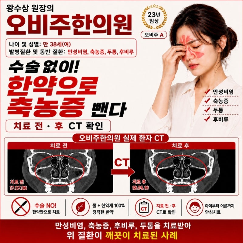 부비동염, 부비동염수술 안하고 낫는방법 만성축농증, 난치성축농증 치료방법