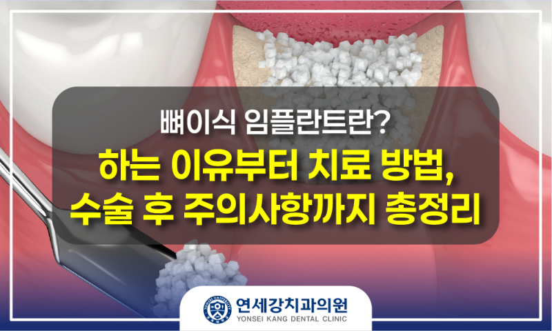 [광주 학동 연세강치과] 뼈이식 임플란트란? 하는 이유부터 치료 방법, 수술 후 주의사항까지....