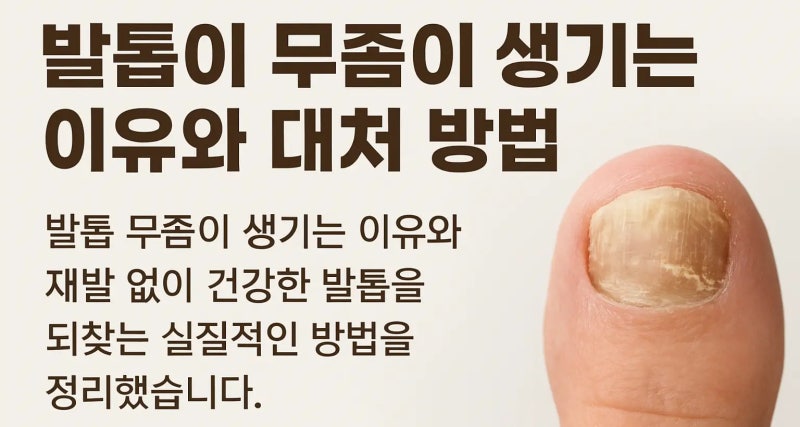 무좀 원인부터 치료까지, 재발 막는 관리법 총정리