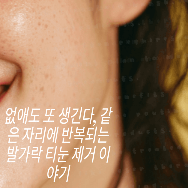 없애도 또 생긴다, 같은 자리에 반복되는 발가락 티눈 제거 이야기