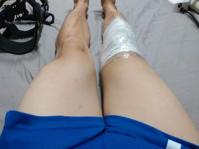 십자인대 완전파열 & 재건술