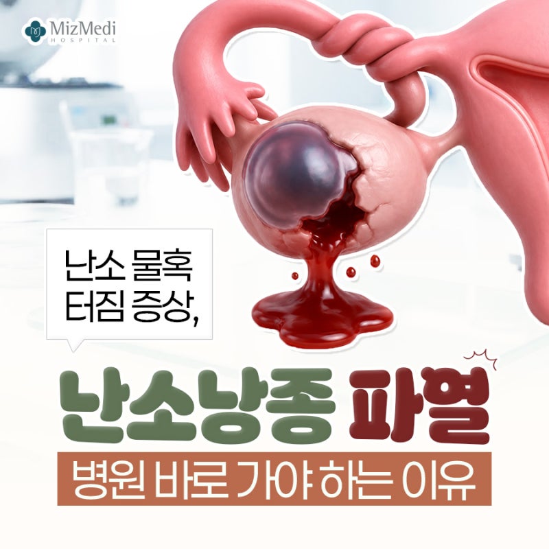 난소 물혹 터짐 증상, 난소낭종 파열 병원 바로 가야 하는 이유