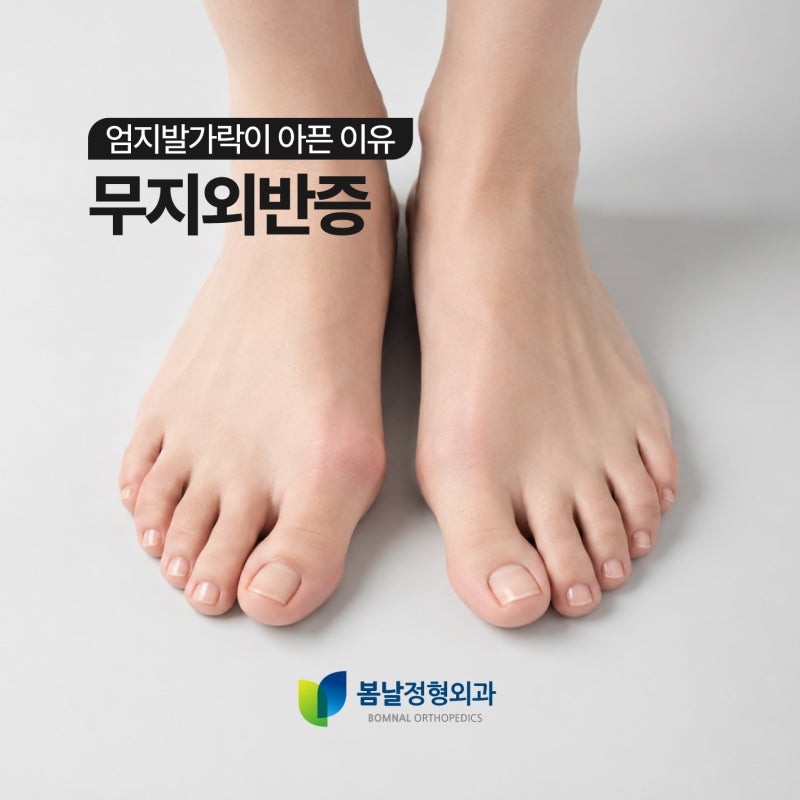 대구 무지외반증, 엄지발가락 뼈가 아픈 이유