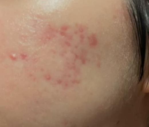 안면 지루성 피부염 원인 증상 얼굴 붉은반점 연고까지 써봤던 사람이 알려드림