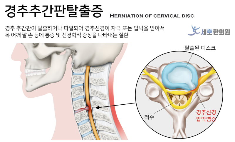 당진 경추추간판탈출증, 목보다 팔과 손이 저리다면 이것을 확인해야 합니다.