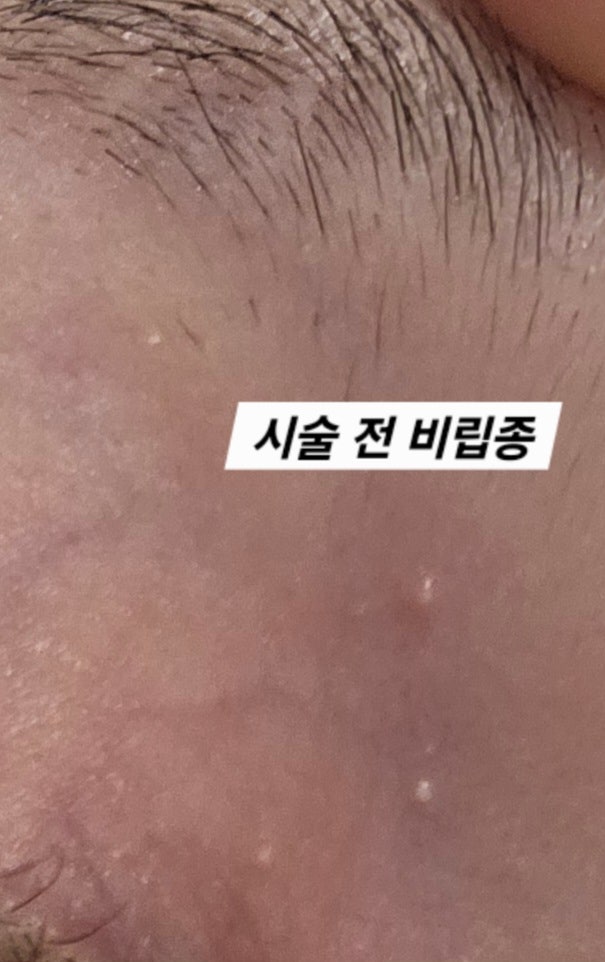 집에서 셀프로 비립종 제거하는 법 꿀팁많음