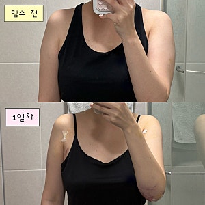 [예신 팔뚝 람스 내돈내산 후기] 무한람스 당일~3일차 통증·멍·붓기·가격