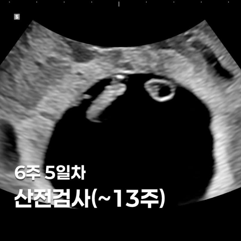 [6주5일차] 용인제일산부인과 임신초기 산전검사 비용