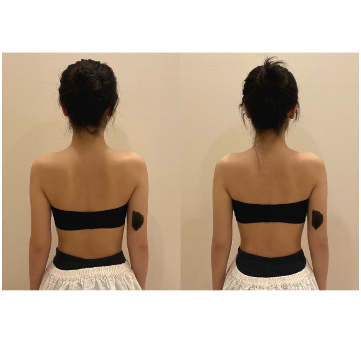 용산 에스테틱 라운드숄더 경락 마사지 위뷰티 용산점 후기 | 바른 자세교정 등살빼는법까지